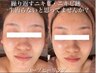 【大人ニキビ・肌荒れ】ハーブピーリング+幹細胞美容液導入でトラブル肌改善