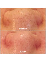 ランティル(l’until)/【鼻の黒ずみが目立たなくなる】