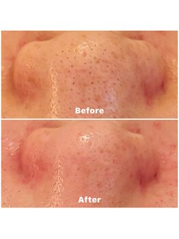 ランティル(l’until)/【鼻の黒ずみが目立たなくなる】