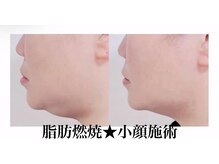 ビ ボーテ(美 Beaute)/脂肪燃焼★小顔施術 症例