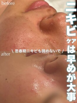 ジェノール 2nd beauty studio 姫路駅前店(JNOEL)/早めのお手入れでトラブル終止符