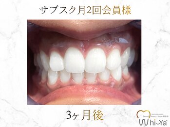 ホワイヤ セルフホワイトニング DBS神楽坂(Whi-Ya)/☆サブスク会員様☆納得の白さ☆