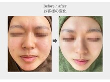 ベル 新橋(Belle)/ハーブピーリング×毛穴ケア