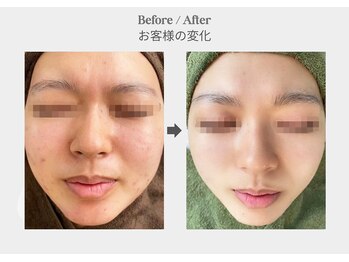 ベル 新橋(Belle)/ハーブピーリング×毛穴ケア