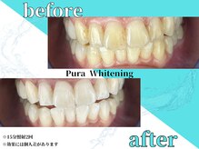 ピュアホワイトニング 横浜店/人気No１ホワイトニング