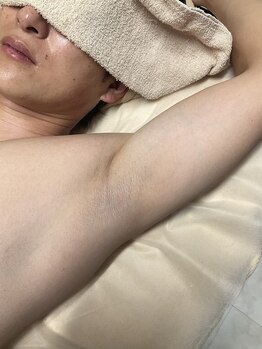 サンスタイルクリア 守山店(SUN STYLE CLEAR)の写真/【中高生にも人気】脱毛デビューは当店にお任せ♪丁寧なカウンセリング×スピーディな施術で効果を実感◇