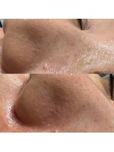 bou 新宿/角栓徹底除去！