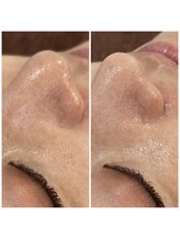 アイリーン(IRENE)/毛穴洗浄の効果実感♪