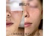 【4週間以内】光フェイシャル+ヒト幹細胞培養液導入/ハリ.くすみ/¥4300