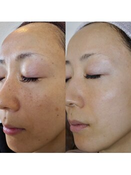 エトル(etole)/30代お客様症例写真