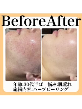 スイ(sui)/Before&After