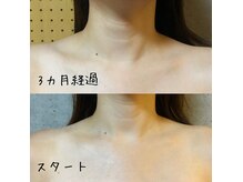 アジアンビューティー癒らゆらの雰囲気（コラーゲンマシン使用の変化。お肌の艶も変わります！）