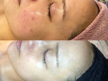 ビジュープラス 広島店(Bijou+)/【30代/繰り返しニキビ】