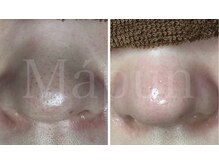 マプン(Mapun)の雰囲気（毛穴の悩みお任せ下さい！黒ずみ、皮脂詰まり、開き解消します。）