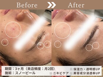 ファッショニスタ 恵比寿東口(Fashionista)/スノーピール/ニキビケア