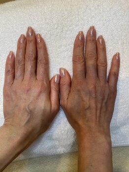 石井クリニック美容研究所エステティク 熊本サロン/お客様の施術後です。