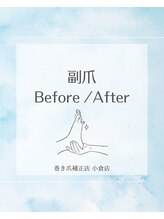 巻き爪補正店 小倉店/【副爪】