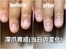 深爪育成