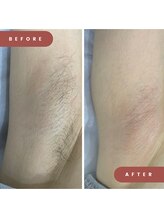 ルナビー 銀座店(Lunaby)/レディース脇シュガーリング