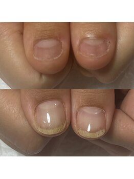 セラキュアネイル(Theracure nail)/深爪緩和の3ヶ月の変化