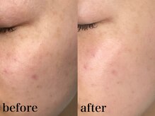 メロウ(me: llow)/剥けないOHLハーブピーリング