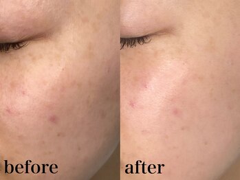 メロウ(me: llow)/剥けないOHLハーブピーリング