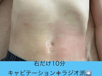 アスピリア(aspirer a')/脂肪燃焼！痩身1箇所集中ケア