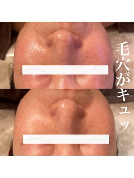 アーブル(Agreable)/毛穴/毛穴開き/小顔