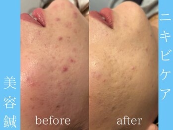 ビープラス(BEE PLUS)/ニキビケア