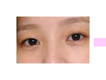 クロム アイプラス 狭山 入曽店(CHROM eye+)/腫れぼったく眠たげなまぶたに！