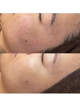 ベリスユイット(BELLIS HUIT)/【剥離なしハーブピーリング】