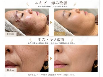 ムーン(moon)の写真/【肌質改善】IPL光フェイシャル×ハーブピーリングで透明感あふれるツヤ肌へ♪