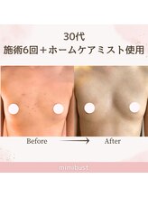 ミミバスト(mimibust)/バストアップBeforeAfter