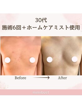 ミミバスト(mimibust)/バストアップBeforeAfter