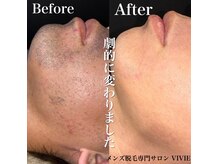 ビビィ(VIVIE)の雰囲気（毎日のヒゲ剃りが面倒でカミソリ負けや肌荒れが気になる方）