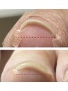 巻き爪ケア　ヘイスイッチ