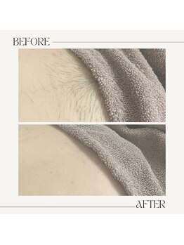 ワンダー(Wonder)/機械脱毛後のVIO施術★人気です