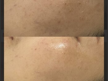 エース(ace)/艶肌爆誕セラピール