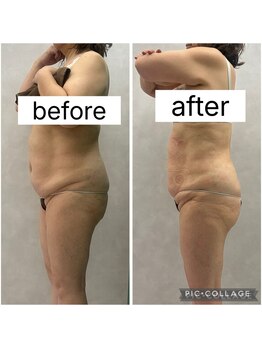 エクラ(Eclat)/Eclatの痩身★BeforeAfter15