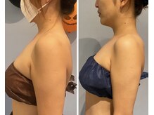 エイシスグロウ(asis glow.)/効果写真