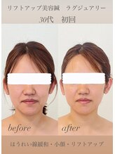 めい鍼灸院/美容鍼灸　ビフォーアフター