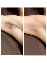 メローワックス 松本駅前店(MELLOW WAX)/ワキのワックス脱毛