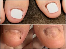 グレースレディ/ 【深爪　長さだしフィルイン】