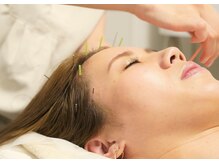 アモ(amo)/頭皮鍼