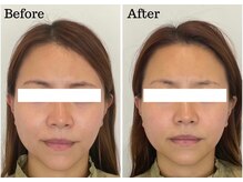 カドモリ 心斎橋(KADOMORI)/美容鍼1回【美容鍼/大阪美容鍼】