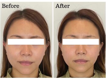 カドモリ 心斎橋(KADOMORI)/美容鍼1回【美容鍼/大阪美容鍼】