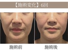 ドクターボディ 恵比寿店(Dr.Body)/【顔の長さ/ほうれい線 40代】