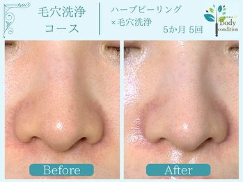 ボディコンディション/ハーブピーリング/毛穴洗浄/小顔