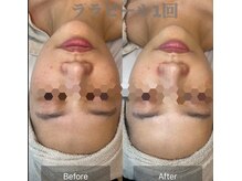 リツイート(ReTweet)の雰囲気（韓国肌管理ララピール）