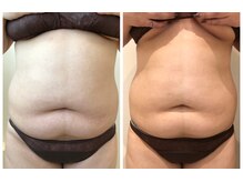 エイシスグロウ(asis glow.)/効果写真